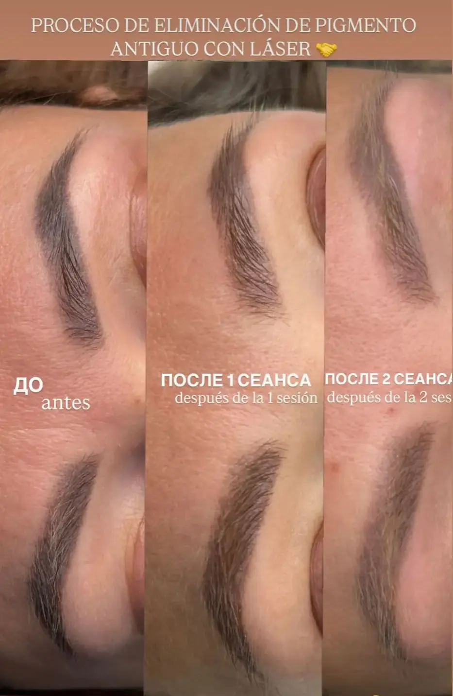 Eliminación-de-Tatuajes