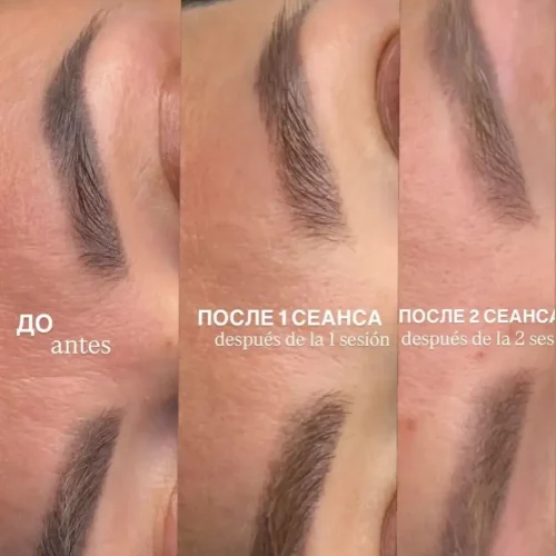 Eliminación-de-Tatuajes